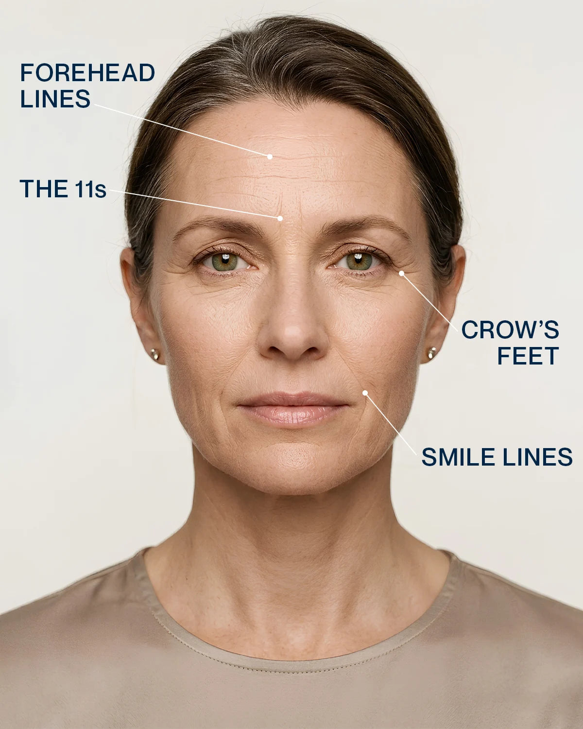 Face map of the expression zones: forehead lines, the 11s, crow's feet and smile lines